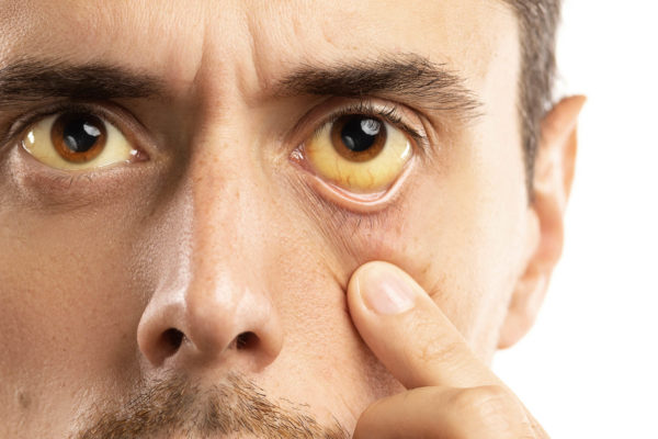 Man checking his health condition. Yellowish eyes is sign of problems with liver, viral infection or other disease.